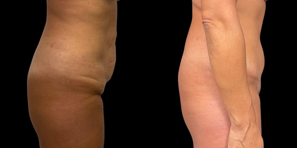 Tummy Tuck Before & After Gallery - Patient 169712 - Image 3