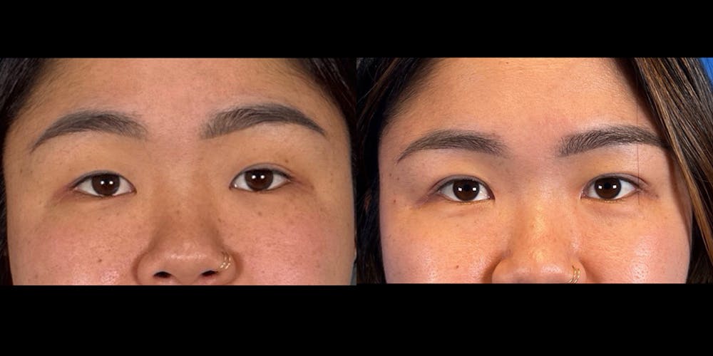 Eyelid Surgery Before & After Gallery - Patient 382256 - Image 1