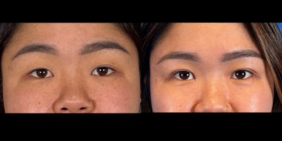 Eyelid Surgery Before & After Gallery - Patient 382256 - Image 1
