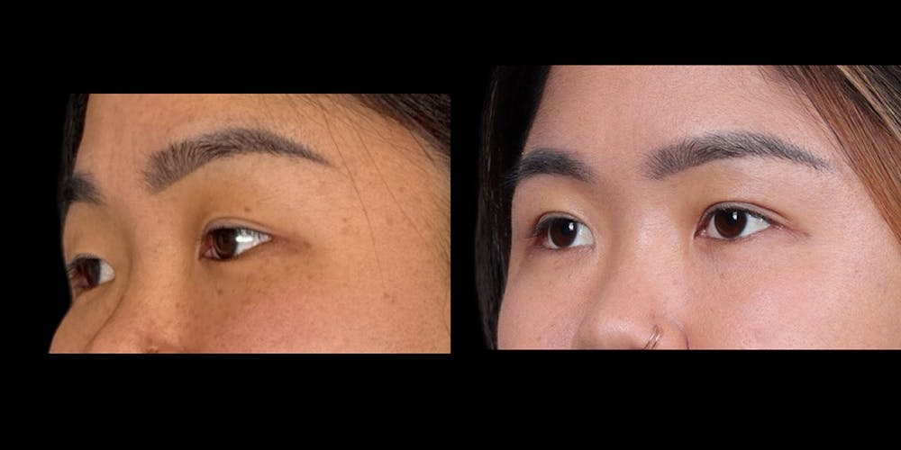 Eyelid Surgery Before & After Gallery - Patient 382256 - Image 3