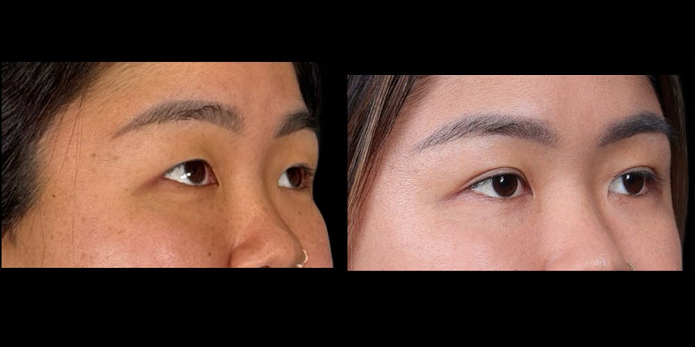 Eyelid Surgery Before & After Gallery - Patient 382256 - Image 2