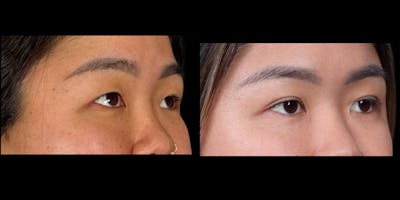 Eyelid Surgery Before & After Gallery - Patient 382256 - Image 2