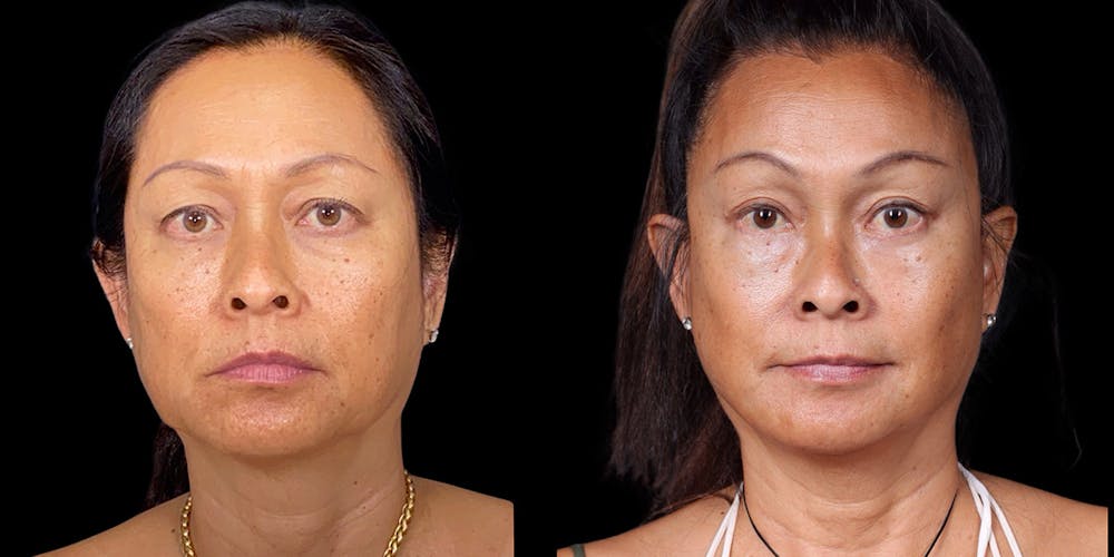 Facelift Before & After Gallery - Patient 376385 - Image 1