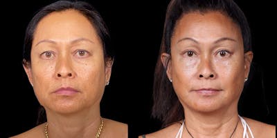 Facelift Before & After Gallery - Patient 376385 - Image 1