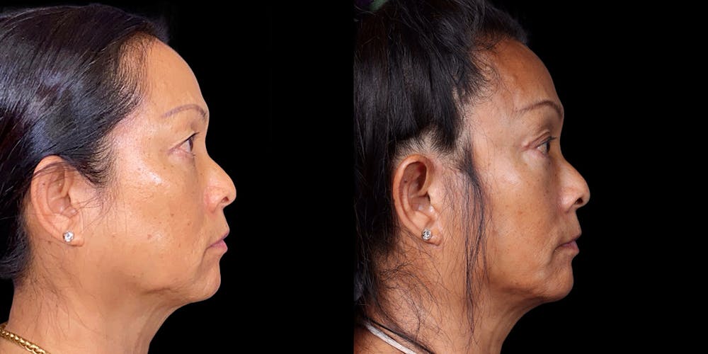 Facelift Before & After Gallery - Patient 376385 - Image 3