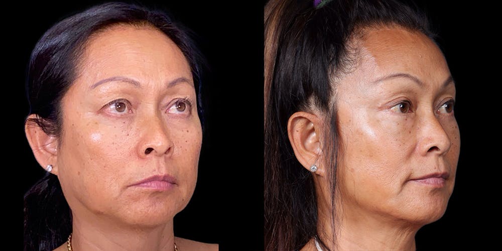 Facelift Before & After Gallery - Patient 376385 - Image 2