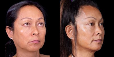 Facelift Before & After Gallery - Patient 376385 - Image 2