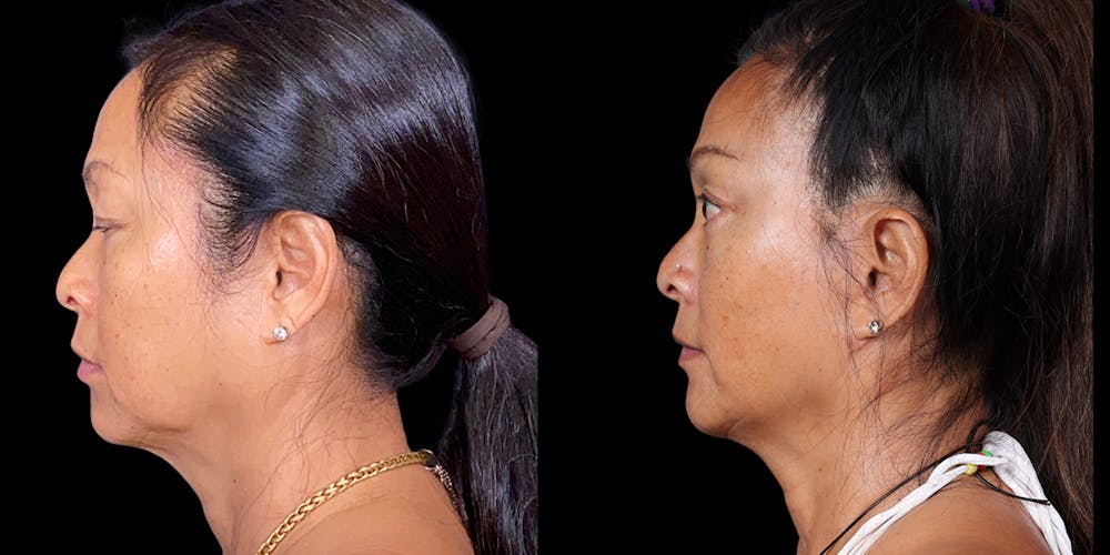 Facelift Before & After Gallery - Patient 376385 - Image 5