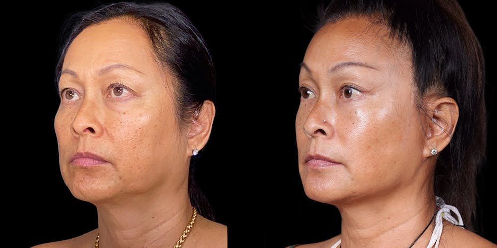 Facelift Before & After Gallery - Patient 376385 - Image 4