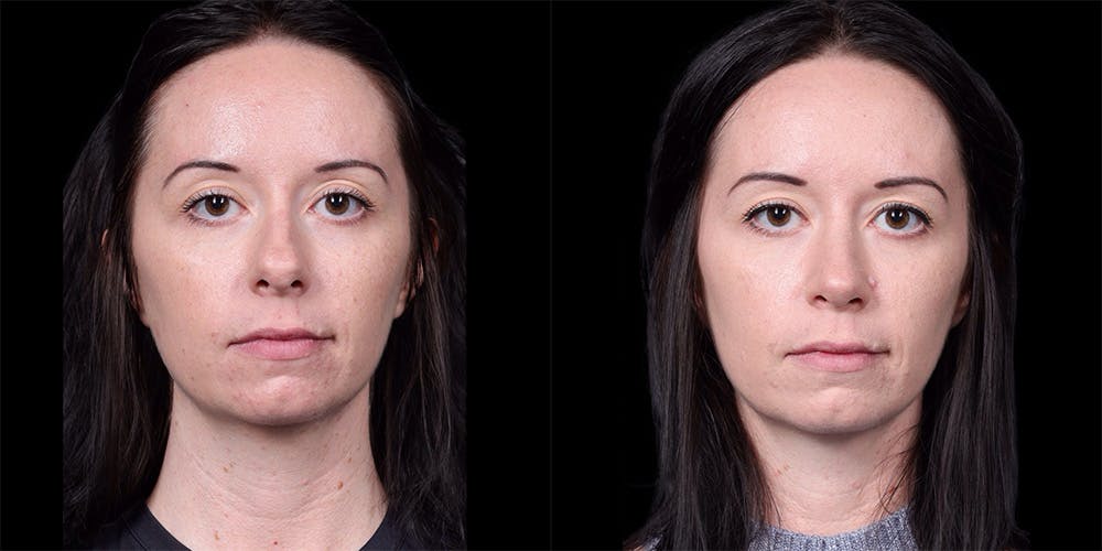 Rhinoplasty Before & After Gallery - Patient 186589 - Image 3