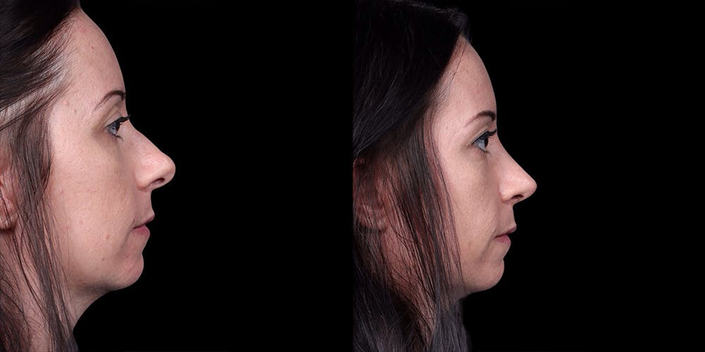 Rhinoplasty Before & After Gallery - Patient 186589 - Image 1