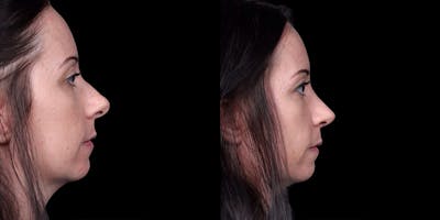 Rhinoplasty Before & After Gallery - Patient 186589 - Image 1