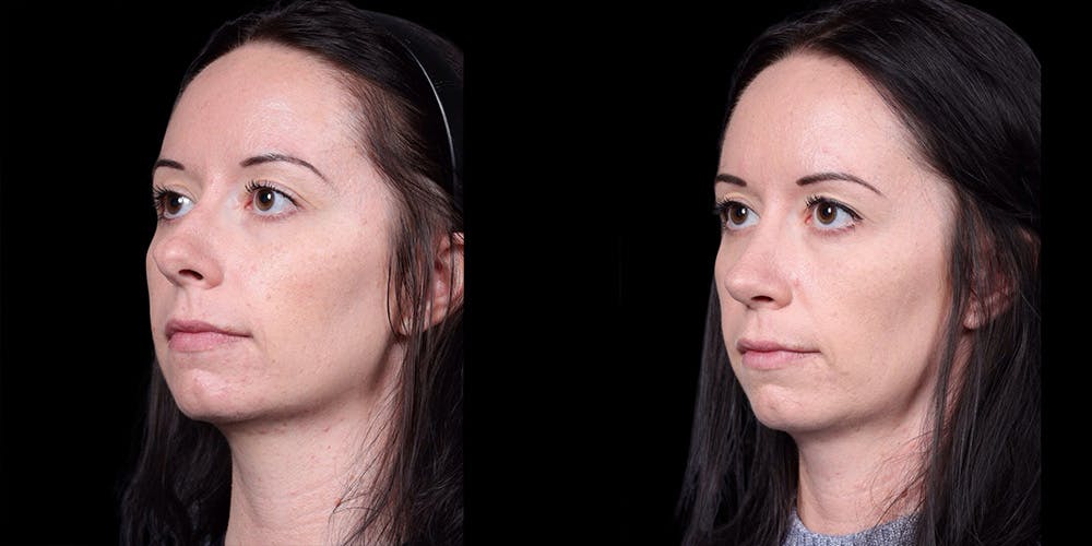 Rhinoplasty Before & After Gallery - Patient 186589 - Image 4