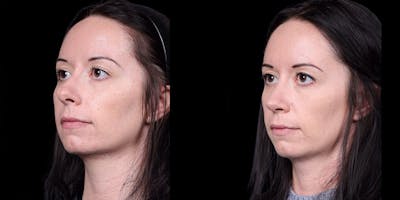 Rhinoplasty Before & After Gallery - Patient 186589 - Image 4