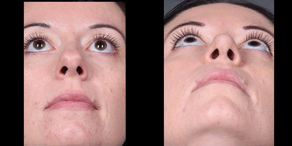 Rhinoplasty Before & After Gallery - Patient 186589 - Image 5