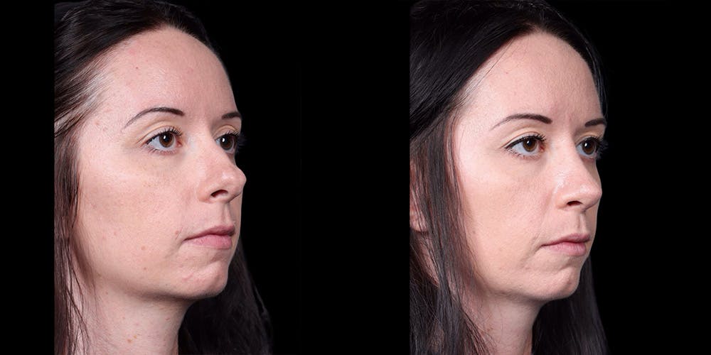 Rhinoplasty Before & After Gallery - Patient 186589 - Image 2