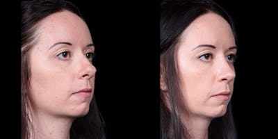 Rhinoplasty Before & After Gallery - Patient 186589 - Image 2