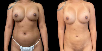 Laser Liposuction Before & After Gallery - Patient 336260 - Image 1