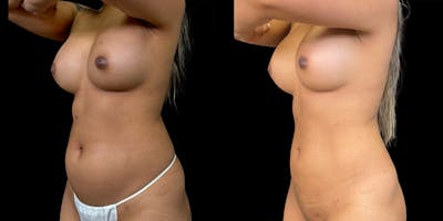 Laser Liposuction Before & After Gallery - Patient 336260 - Image 4