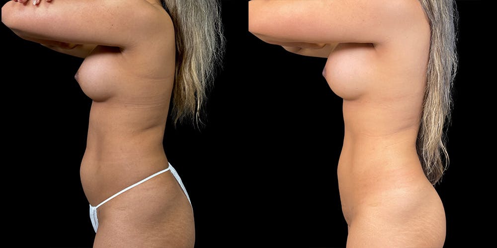 Laser Liposuction Before & After Gallery - Patient 336260 - Image 5