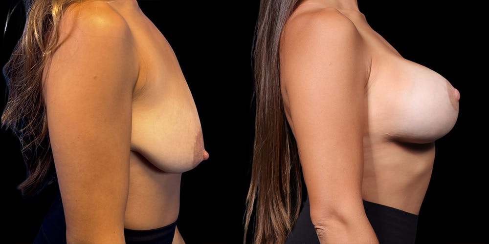 Breast Lift with Implants Before & After Gallery - Patient 38290664 - Image 4