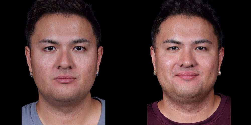 Rhinoplasty Before & After Gallery - Patient 389001 - Image 3