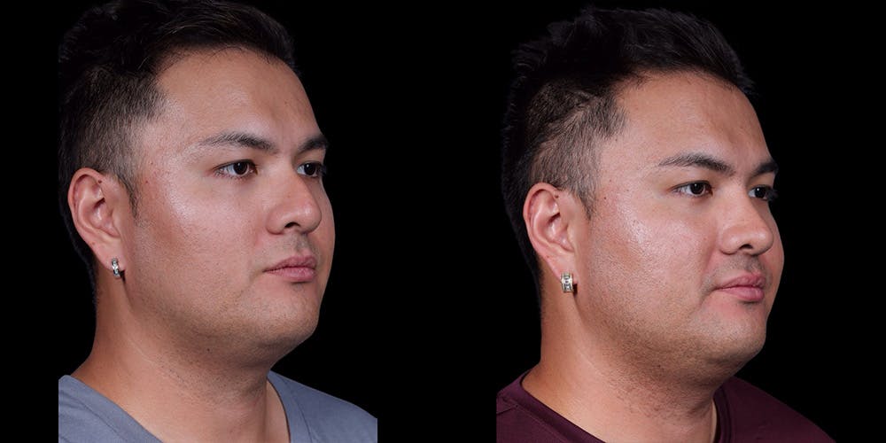Rhinoplasty Before & After Gallery - Patient 389001 - Image 2