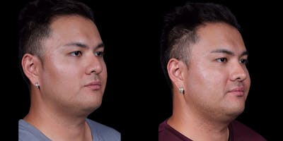 Rhinoplasty Before & After Gallery - Patient 389001 - Image 2