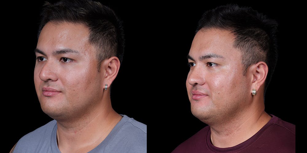 Rhinoplasty Before & After Gallery - Patient 389001 - Image 4