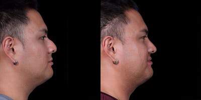 Rhinoplasty Before & After Gallery - Patient 389001 - Image 1