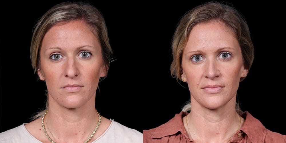 Rhinoplasty Before & After Gallery - Patient 319059 - Image 3