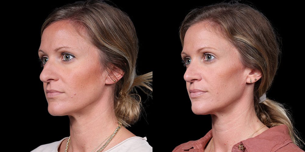 Rhinoplasty Before & After Gallery - Patient 319059 - Image 2