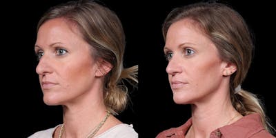 Rhinoplasty Before & After Gallery - Patient 319059 - Image 2