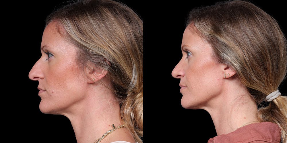 Rhinoplasty Before & After Gallery - Patient 319059 - Image 1