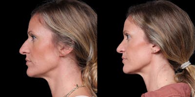 Rhinoplasty Before & After Gallery - Patient 319059 - Image 1
