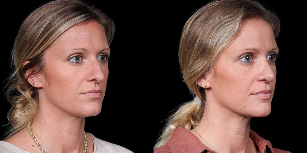 Rhinoplasty Before & After Gallery - Patient 319059 - Image 4