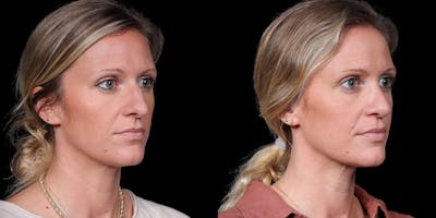 Rhinoplasty Before & After Gallery - Patient 319059 - Image 4