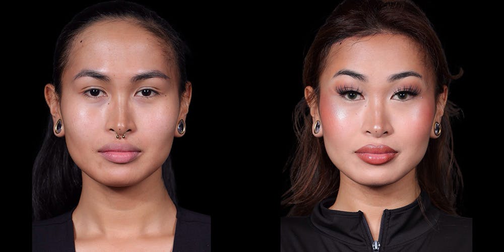 Facial Feminization Surgery Before & After Gallery - Patient 340641 - Image 1