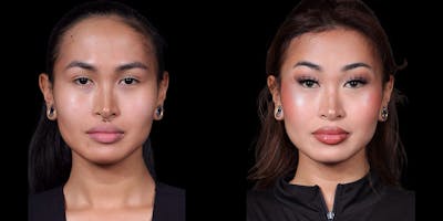 Facial Feminization Surgery Before & After Gallery - Patient 340641 - Image 1
