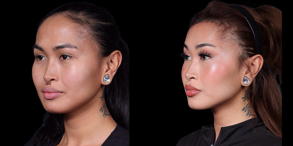 Facial Feminization Surgery Before & After Gallery - Patient 340641 - Image 4