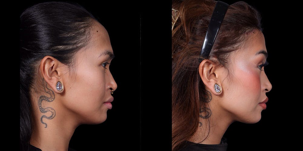 Facial Feminization Surgery Before & After Gallery - Patient 340641 - Image 3