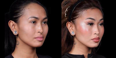 Facial Feminization Surgery Before & After Gallery - Patient 340641 - Image 2