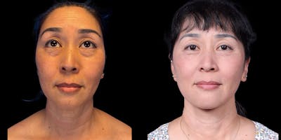 Neck Lift Before & After Gallery - Patient 348425 - Image 1