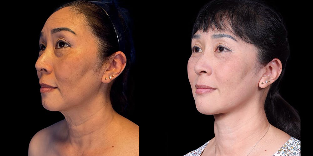 Neck Lift Before & After Gallery - Patient 348425 - Image 4