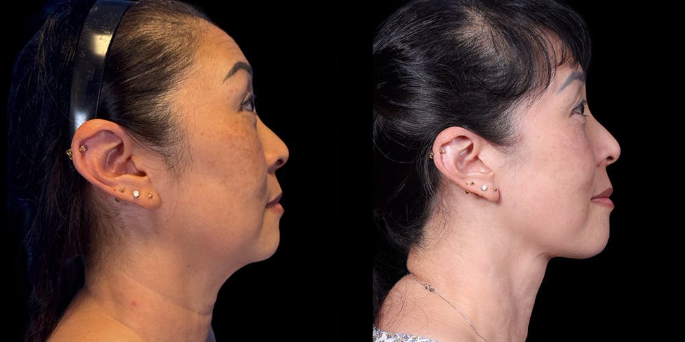 Neck Lift Before & After Gallery - Patient 348425 - Image 3