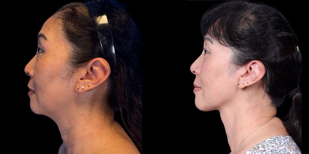 Neck Lift Before & After Gallery - Patient 348425 - Image 5