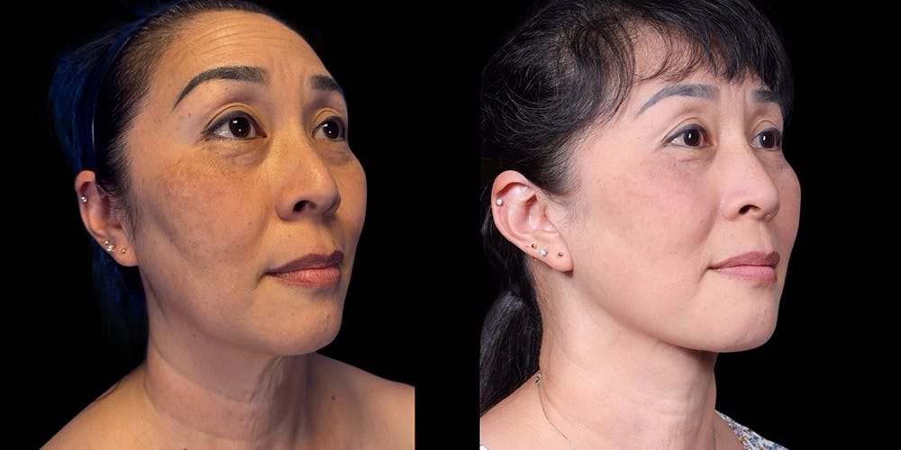 Neck Lift Before & After Gallery - Patient 348425 - Image 2
