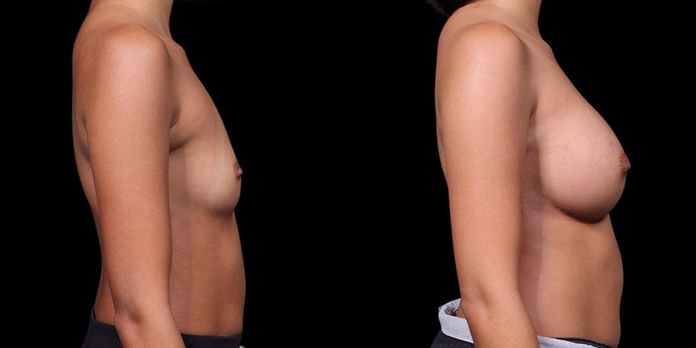 Breast Augmentation Before & After Gallery - Patient 402910 - Image 4