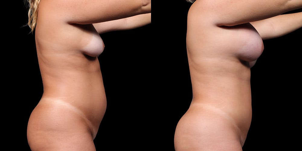 Breast Augmentation Before & After Gallery - Patient 164531 - Image 4