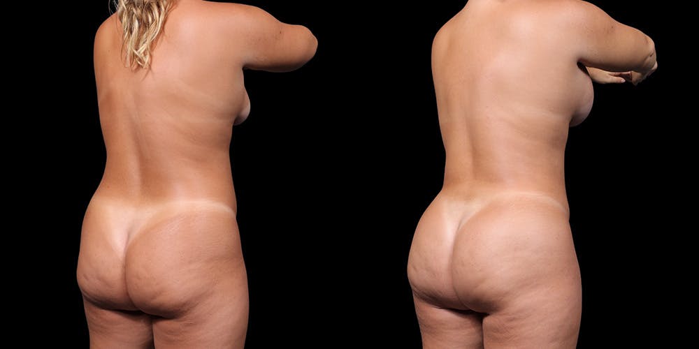 Breast Augmentation Before & After Gallery - Patient 164531 - Image 3